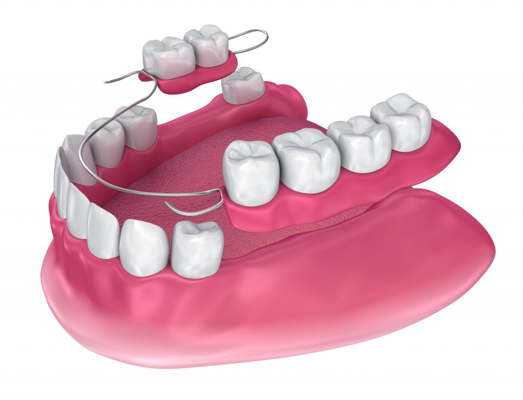 Full And Partial Dentures - New Hope Dental Care