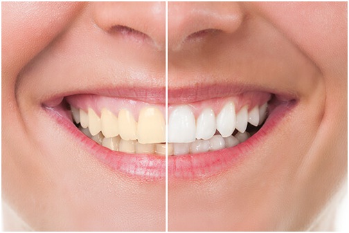 teeth whitening raleigh nc