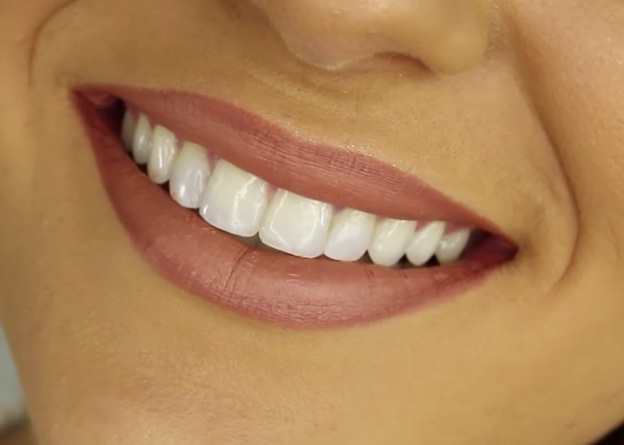 teeth whitening raleigh nc